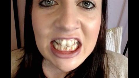 First month slideshow of my Six Month Smiles braces progress.... - YouTube