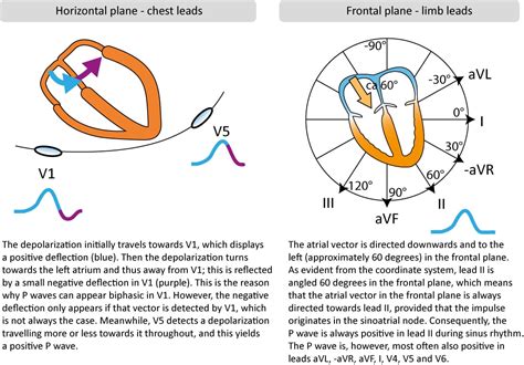 P-wave, PR interval, PR segment: physiology, criteria & ECG findings ...