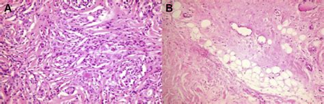 e (A, B) Typical histopathology of Riedel's thyroiditis showing atrophy ...