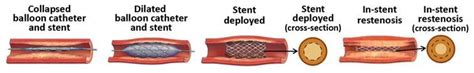 Freedom from In-stent-Restenosis – ThePrint – ANIPressReleases