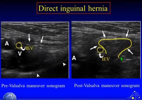 Valsalva Hernia Inguinal - Noticias Formosago