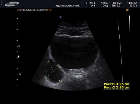 Diverticulum of the bladder (With images) | Ultrasound, Ultrasound ...