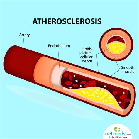 Atherosclerosis - Causes, Symptoms And Treatment | Netmeds