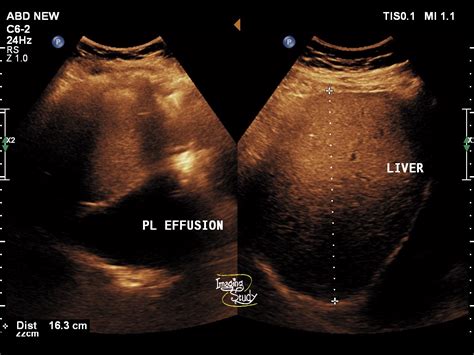 Case 16: Pleural Effusion Ultrasound