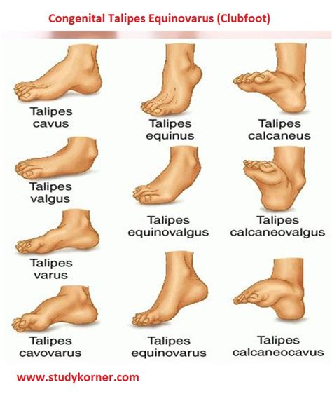 Congenital Talipes Equinovarus (Clubfoot) Nursing Cheat Sheet - StudyPK