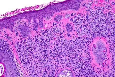 Intradermal Nevus Histology