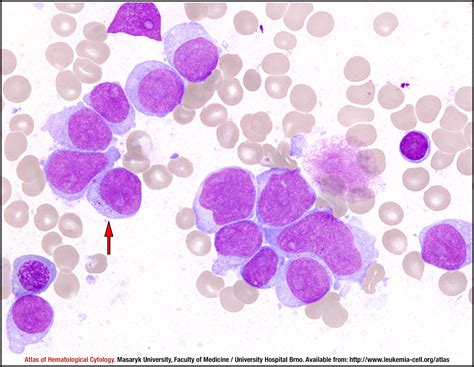 Acute myeloid leukaemia without maturation - CELL - Atlas of ...