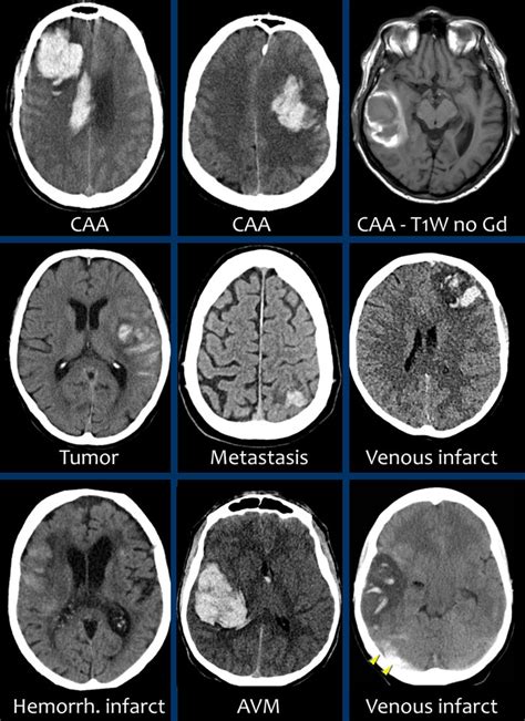 Brain Hemorrhage Scan