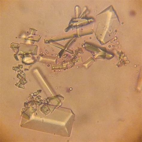 Picture of struvite crystals in the urine of a 3.5 year old dog ...