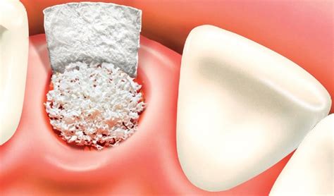 Bone Graft Vancouver - Bone Graft Options for Dental Implants