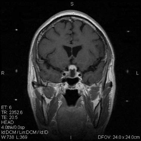 Typical MRI scan changes in prolactinomas adenoma. Coronal T1-weighted ...