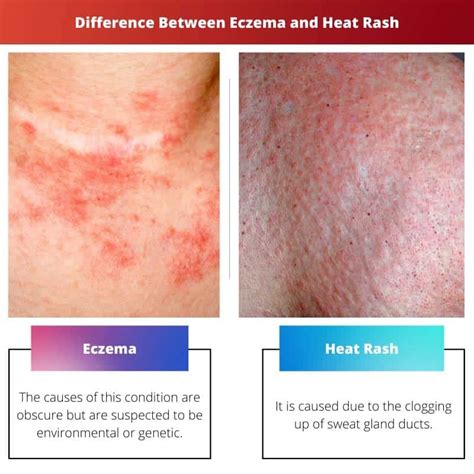 Eczema Rash Duration at Timothy Bailey blog