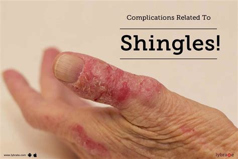 Complications Related To Shingles! - By Dr. Sushma Yadav | Lybrate