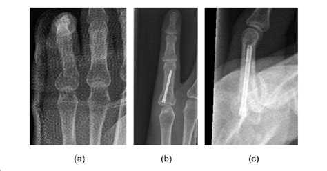 A common type of transverse fracture to the base of the proximal ...