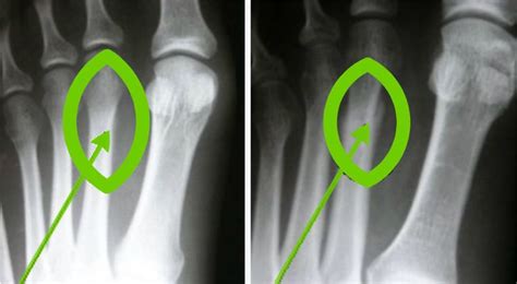 Metatarsal Stress Fracture: Diagnosis | SLO Motion Shoes