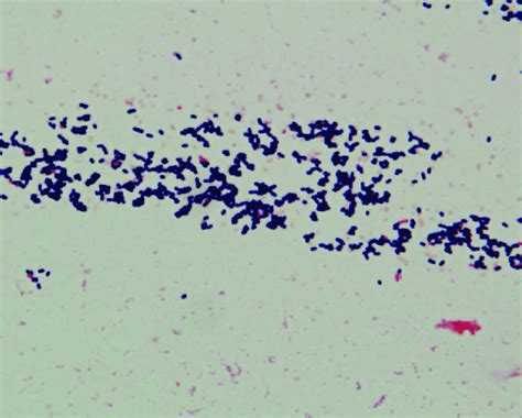 Gram stain of a blood culture indicates the presence of gram-positive ...