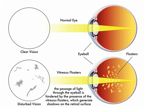 When To Be Concerned with Eye Floaters - Eye Clinic of Florida