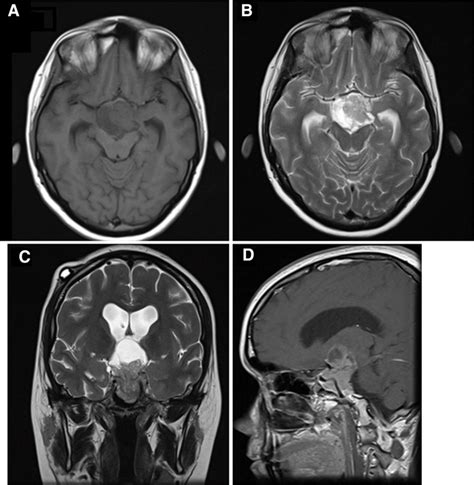 First pituitary magnetic resonance imaging with a giant prolactinoma ...