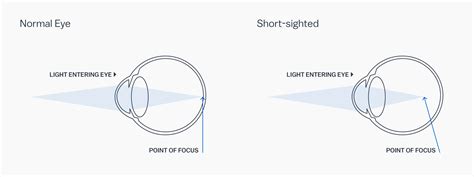 Glasses Direct ™ - Best Lenses for Your prescription