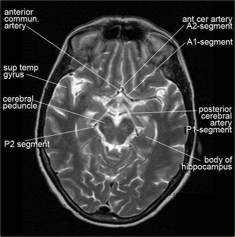 Anatomy Of Brain Ct Scan Anatomy Drawing Diagram | Images and Photos finder