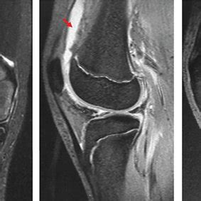 Simple MRI (T2-enhanced) at the time of injury. Mild bone marrow edema ...