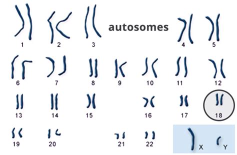 Expecting a Child | Trisomy 18 Foundation