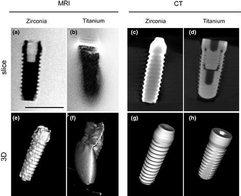 Imaging of zirconia and titanium implants. Magnetic resonance imaging ...