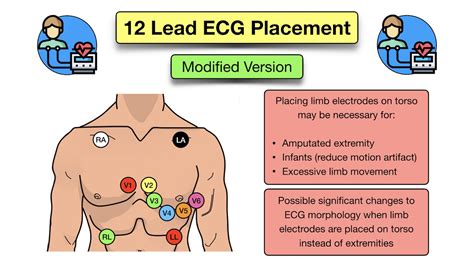 12 Lead ECG Placement: Diagram And Mnemonic For Limb And, 60% OFF