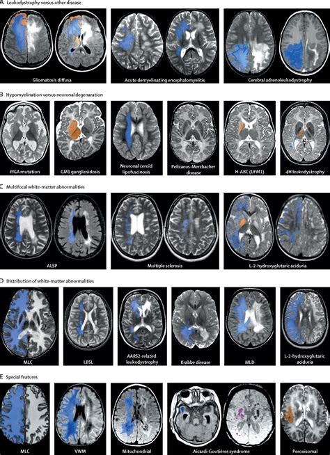 Diagnosis, prognosis, and treatment of leukodystrophies - The Lancet ...