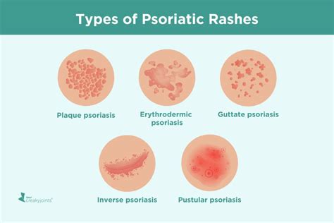 Psoriatic Arthritis Rash: Symptoms, Treatment, and Pictures