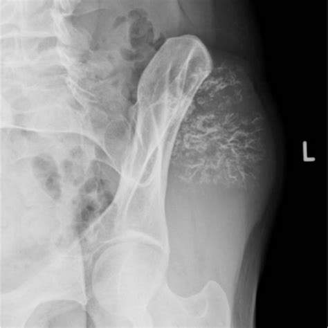 Peripheral Chondrosarcoma | Eurorad