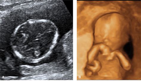 Trisomy 18 Ultrasound