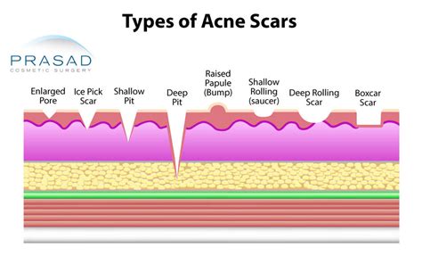 Acne Scars Treatment | NYC and Long Island | Prasad Cosmetic Surgery