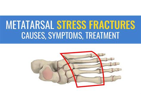 Metatarsal stress fractures – Causes, symptoms, and treatment