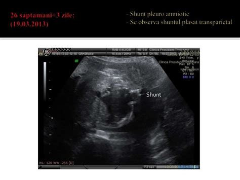 Hidrotorax fetal shunt pleuro amniotic