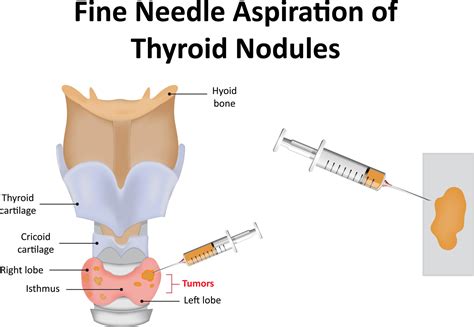 Fine Needle Aspiration of Thyroid Nodules - MMRA