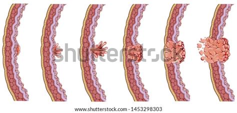 Illustration That Shows Phases Stages Tumor Stock Illustration ...