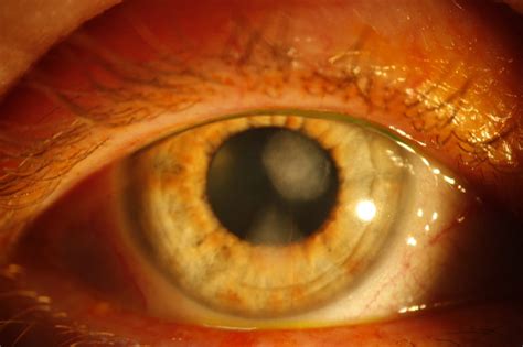 Herpes Simplex Keratitis3 - Eyes Wide Bay