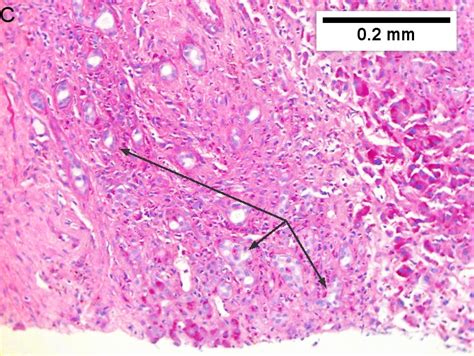 Cholangiocarcinoma - Libre Pathology