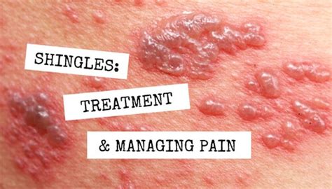 Shingles: Treatment and Managing Pain | WCEI