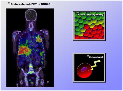 Pet Scan Images Lung Cancer