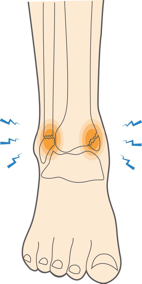 What are Ankle Fractures or Broken Ankle Injuries? - Upswing Health