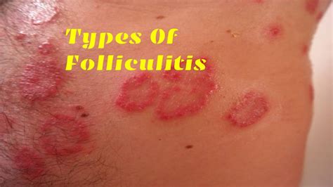 Folliculitis: What Is Folliculitis? Its Symptoms, Causes, And More