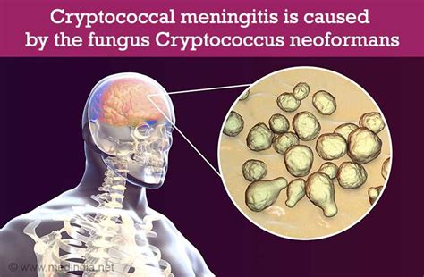 Cryptococcal Meningitis - Causes, Risk Factors, Symptoms, Diagnosis ...