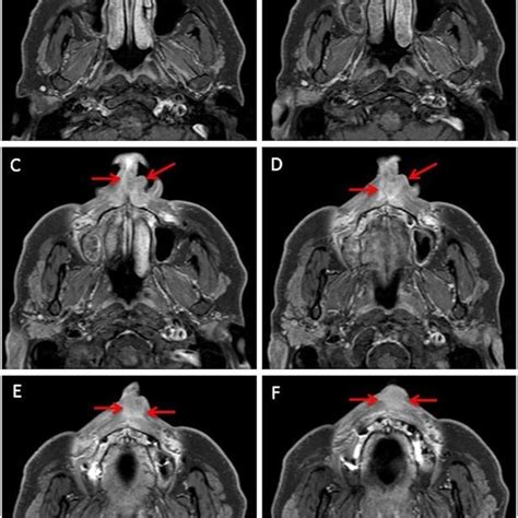 Nasal tumor at initial consultation (A), progression before therapy ...