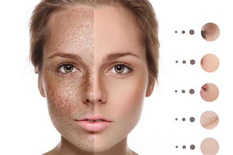 What Is Hyperpigmentation Laser Treatment? Your Guide