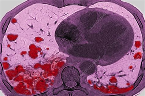 Lung metastases, CT scan - Stock Image - C055/5052 - Science Photo Library