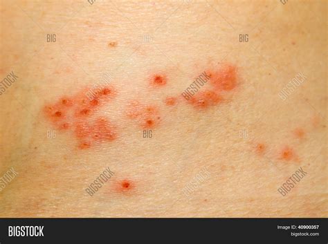 Shingles Rash Stock Photo & Stock Images | Bigstock