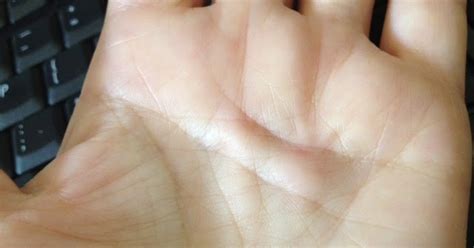 MARIETTE'S BACK TO BASICS: {My Hand and Dupuytren's Contracture}