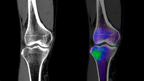 Traumatic Bone Marrow Edema of the Lower Limb - Siemens Healthineers USA